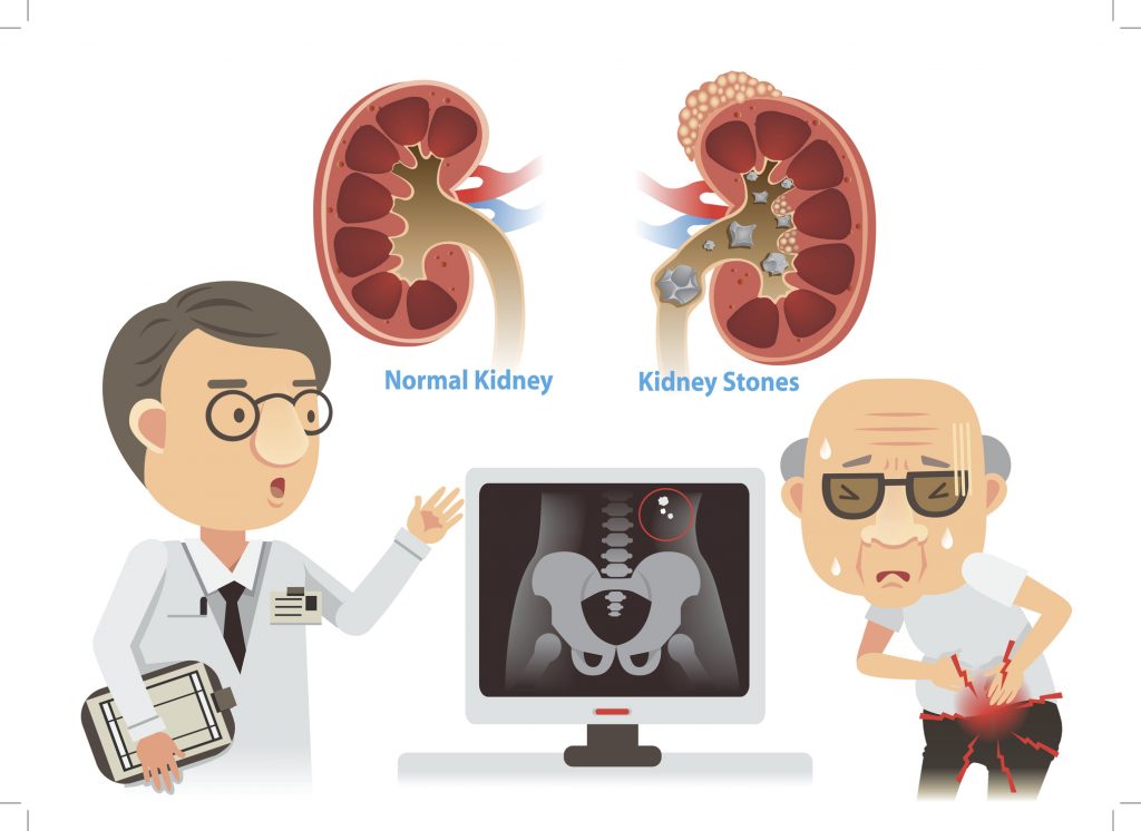 Blast them or pass them: treatments for kidney stones - SAIU